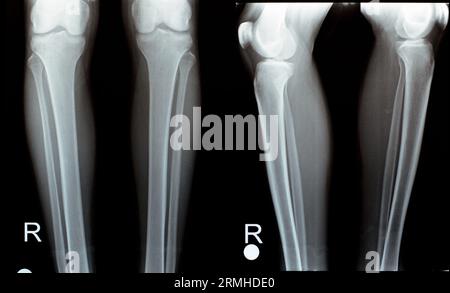 Radiographie simple des articulations droite et gauche du genou avec partie inférieure du fémur et partie supérieure du tibia, du péroné et de la rotule montrant une articulation normale du genou de A. Banque D'Images