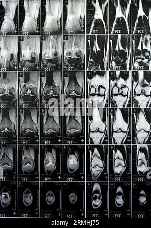 IRM du genou droit montrant un léger épanchement articulaire, avec d'autres résultats normaux de PHMM, LCA, MCL, LCL, LM, ligaments, rotule, tendons, nerfs, muscles Banque D'Images