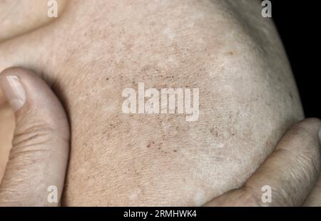 Taches d'âge sur le corps de l'homme asiatique aîné. Ce sont des taches brunes, grises ou noires et aussi appelées taches de foie, lentilles séniles, lentilles solaires ou taches solaires Banque D'Images