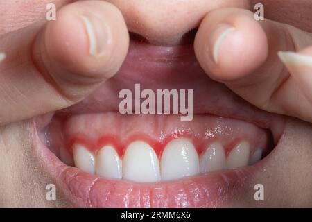 Macro des gencives rouges d'une femme. Inflammation des gencives avec rougeur. Cliché recadré d'une jeune femme montrant des gencives saignantes. Dentisterie, soins dentaires et hygie bucco-dentaire Banque D'Images