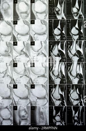 IRM du genou droit montrant un léger épanchement articulaire, avec d'autres résultats normaux de PHMM, LCA, MCL, LCL, LM, ligaments, rotule, tendons, nerfs, muscles Banque D'Images