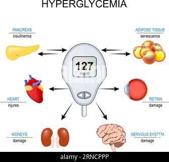 hyperglycémie. Insulinorésistance. Relation entre la cellule sénescente, le taux élevé de sucre dans le sang et les complications du diabète sucré. Vector illustr Illustration de Vecteur