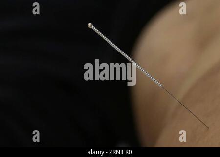 (170120) -- PÉKIN, 20 janvier 2017 -- une image prise le 15 juillet 2015 montre une aiguille insérée dans un patient pendant un traitement d'acupuncture, dans un centre de santé publique de Sao Paulo, au Brésil. Le 18 janvier 2017, le président chinois Xi Jinping a présenté une statue d’acupuncture en bronze à l’Organisation mondiale de la Santé (OMS) à Genève, en Suisse, qui montre des points d’acupuncture sur le corps humain. Selon l'OMS, 103 membres ont approuvé la pratique de l'acupuncture et de la moxibustion, 29 ayant promulgué des lois spéciales sur la médecine traditionnelle et 18 ayant inclus l'acupuncture et la moxibustion Banque D'Images