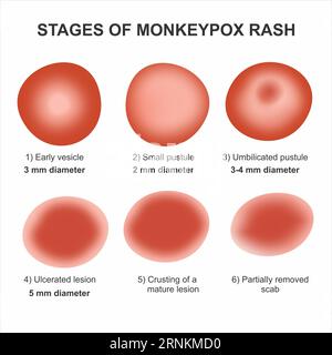 Illustration de l'éruption de la variole du singe par étapes Banque D'Images