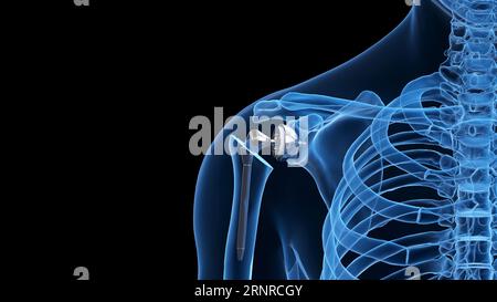 Remplacement de l'épaule, illustration Banque D'Images