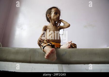 Actualités Themen der Woche kW 36 Actualités Bilder des Tages (180903) -- SANAA, le 3 septembre 2018 -- Une jeune fille de 4 ans souffrant de malnutrition est assise sur un lit en attendant d'être pesée pendant qu'elle reçoit un traitement dans un service de malnutrition d'un hôpital de Sanaa, au Yémen, le 2 septembre 2018. Des millions de personnes dans le Yémen déchiré par la guerre ne peuvent pas obtenir un repas par jour. )(dh) YÉMEN-SANAA-ENFANTS-MALNUTRITION MohammedxMohammed PUBLICATIONxNOTxINxCHN Banque D'Images