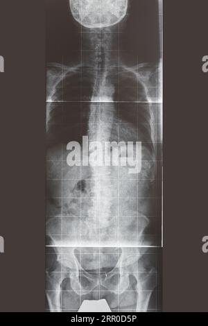 Radiographie du rachis lombaire. Vue avant. Santé. Diagnostic d'image Banque D'Images
