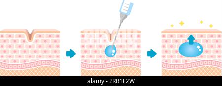 Illustration du mécanisme d'injection d'acide hyaluronique (vue en coupe de la peau) Illustration de Vecteur