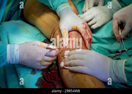Pour traiter les blessures des patients, les spécialistes orthopédiques effectuent des chirurgies sur une jambe. Banque D'Images