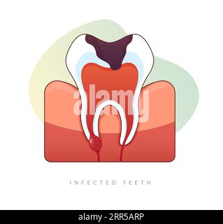 Dents infectées - traitement du canal radiculaire - Illustration stock comme fichier EPS 10 Illustration de Vecteur