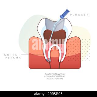 Dents infectées - traitement du canal radiculaire - Illustration stock comme fichier EPS 10 Illustration de Vecteur