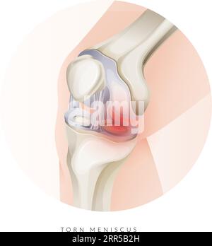 Lésion cartilagineuse du genou - ménisque déchiré - Illustration stock comme fichier EPS 10 Illustration de Vecteur