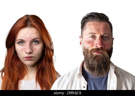 Homme et femme souffrant de rosacée sur la peau du visage. Rougeur et grossissement des capillaires dus à la couperose. Portraits isolés sur fond blanc Banque D'Images