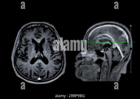 Imagerie cérébrale IRM vue axiale et sagittale avec ligne de référence pour détecter les maladies cérébrales telles que les accidents vasculaires cérébraux, les tumeurs cérébrales et les infections. Banque D'Images