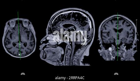 IRM cérébrale vue axiale, coronale et sagittale avec ligne de référence pour détecter les maladies cérébrales telles que les accidents vasculaires cérébraux, les tumeurs cérébrales et les infections. Banque D'Images