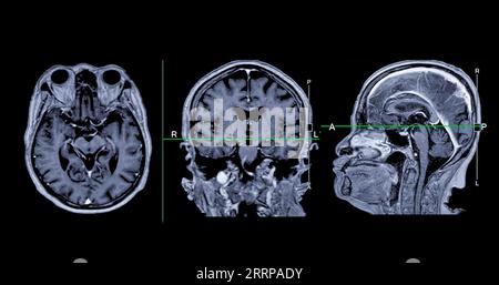 IRM cérébrale vue axiale, coronale et sagittale avec ligne de référence pour détecter les maladies cérébrales telles que les accidents vasculaires cérébraux, les tumeurs cérébrales et les infections. Banque D'Images