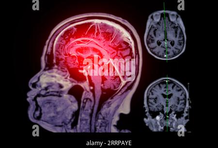 IRM cérébrale vue axiale, coronale et sagittale avec ligne de référence pour détecter les maladies cérébrales telles que les accidents vasculaires cérébraux, les tumeurs cérébrales et les infections. Banque D'Images