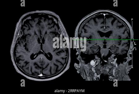Imagerie cérébrale IRM vue axiale et frontale avec ligne de référence pour détecter les maladies cérébrales telles que les accidents vasculaires cérébraux, les tumeurs cérébrales et les infections. Banque D'Images