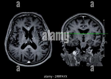 Imagerie cérébrale IRM vue axiale et frontale avec ligne de référence pour détecter les maladies cérébrales telles que les accidents vasculaires cérébraux, les tumeurs cérébrales et les infections. Banque D'Images