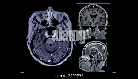 IRM cérébrale vue axiale, coronale et sagittale avec ligne de référence pour détecter les maladies cérébrales telles que les accidents vasculaires cérébraux, les tumeurs cérébrales et les infections. Banque D'Images
