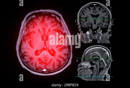 IRM cérébrale vue axiale, coronale et sagittale avec ligne de référence pour détecter les maladies cérébrales telles que les accidents vasculaires cérébraux, les tumeurs cérébrales et les infections. Banque D'Images