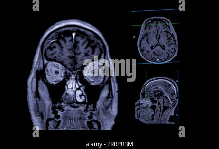 IRM cérébrale vue axiale, coronale et sagittale avec ligne de référence pour détecter les maladies cérébrales telles que les accidents vasculaires cérébraux, les tumeurs cérébrales et les infections. Banque D'Images