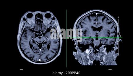 Imagerie cérébrale IRM vue axiale et frontale avec ligne de référence pour détecter les maladies cérébrales telles que les accidents vasculaires cérébraux, les tumeurs cérébrales et les infections. Banque D'Images
