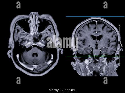 Imagerie cérébrale IRM vue axiale et frontale avec ligne de référence pour détecter les maladies cérébrales telles que les accidents vasculaires cérébraux, les tumeurs cérébrales et les infections. Banque D'Images