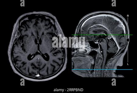 Imagerie cérébrale IRM vue axiale et sagittale avec ligne de référence pour détecter les maladies cérébrales telles que les accidents vasculaires cérébraux, les tumeurs cérébrales et les infections. Banque D'Images