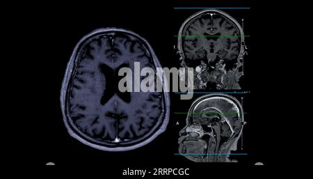 IRM cérébrale vue axiale, coronale et sagittale avec ligne de référence pour détecter les maladies cérébrales telles que les accidents vasculaires cérébraux, les tumeurs cérébrales et les infections. Banque D'Images