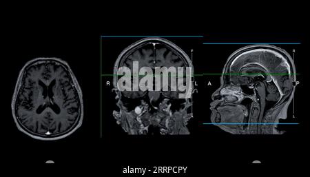 IRM cérébrale vue axiale, coronale et sagittale avec ligne de référence pour détecter les maladies cérébrales telles que les accidents vasculaires cérébraux, les tumeurs cérébrales et les infections. Banque D'Images
