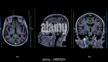 IRM cérébrale vue axiale, coronale et sagittale avec ligne de référence pour détecter les maladies cérébrales telles que les accidents vasculaires cérébraux, les tumeurs cérébrales et les infections. Banque D'Images