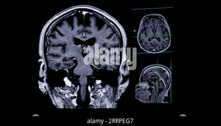 IRM cérébrale vue axiale, coronale et sagittale avec ligne de référence pour détecter les maladies cérébrales telles que les accidents vasculaires cérébraux, les tumeurs cérébrales et les infections. Banque D'Images