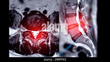 IRM rachis L-S ou rachis lombaire technique T2 axiale et sagittale avec ligne de référence pour le diagnostic de compression médullaire. Banque D'Images