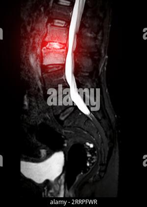 IRM rachis L-S ou rachis lombaire sagittal T2 technique de suppression de graisse pour le diagnostic de compression médullaire. Banque D'Images