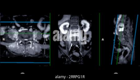 IRM rachis L-S ou rachis lombaire sagittal T2 pour le diagnostic de compression médullaire. Banque D'Images