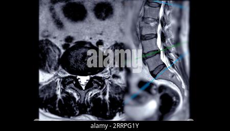 IRM rachis L-S ou rachis lombaire technique T2 axiale et sagittale avec ligne de référence pour le diagnostic de compression médullaire. Banque D'Images