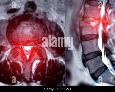 IRM rachis L-S ou rachis lombaire technique T2 axiale et sagittale avec ligne de référence pour le diagnostic de compression médullaire. Banque D'Images