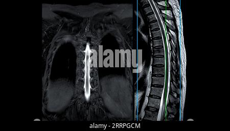 IRM du rachis T-L ou thoraco-sacré technique T2 coronaire et sagittale avec ligne de référence pour le diagnostic de compression médullaire. Banque D'Images