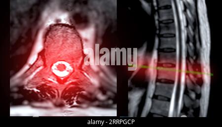 IRM rachis T-L ou thoraco-sacré technique T2 axiale et sagittale avec ligne de référence pour le diagnostic de compression médullaire. Banque D'Images