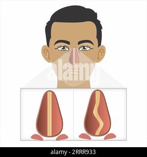 Lésion du cartilage nasal cassé illustration Banque D'Images