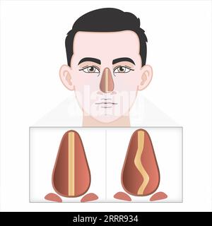 Lésion du cartilage nasal cassé illustration Banque D'Images