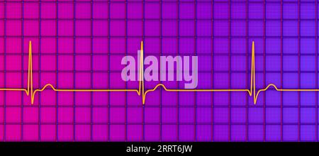 Rythme jonctionnel du rythme cardiaque, illustration Banque D'Images