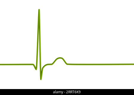 Rythme jonctionnel du rythme cardiaque, illustration Banque D'Images