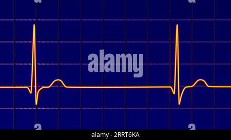 Rythme jonctionnel du rythme cardiaque, illustration Banque D'Images