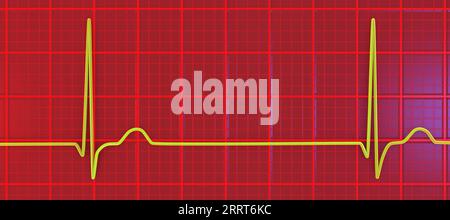 Rythme jonctionnel du rythme cardiaque, illustration Banque D'Images