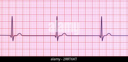 Rythme jonctionnel du rythme cardiaque, illustration Banque D'Images