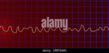 Fibrillation ventriculaire rythme cardiaque, illustration Banque D'Images