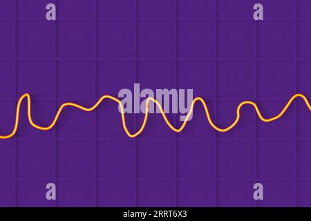 Fibrillation ventriculaire rythme cardiaque, illustration Banque D'Images