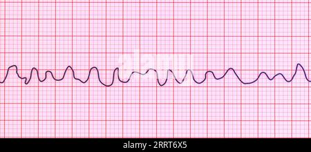 Fibrillation ventriculaire rythme cardiaque, illustration Banque D'Images